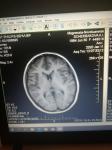Расшифровка МРТ мозга фото 5