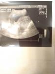 Предлежание хориона на 11 неделе беременности фото 1