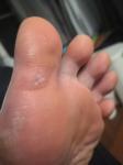 Плотное образование на пальце ноги фото 1