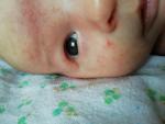 Сыпь у младенца на лице фото 3