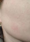Воспаление кожи на щеках фото 2