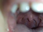 Белые точки в горле у ребенка фото 2