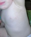 Сыпь подмышкой у ребёнка с одной стороны фото 1