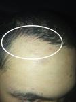 Восстановление волос после псориаза фото 1