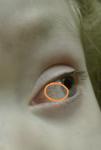 Образование на белке глаза у ребенка фото 1