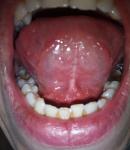 Воспаление под языком фото 2