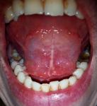 Воспаление под языком фото 1