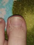 Чешуйкообразное образование вокруг ногтей пальцев ног фото 1