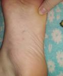 Чешуйкообразное образование вокруг ногтей пальцев ног фото 2