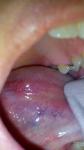 Уплотнение в язике под слизистой фото 2