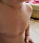 Чешуйчатое пятно на груди у ребенка фото 2