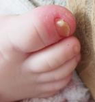 Изменение ногтей и кожи у ребенка 1,5 года фото 4