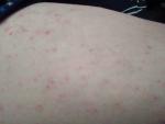 2 месяца наблюдаю прыщи на теле. Может ли это быть аллергия? фото 2