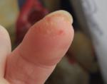 Видоизменение кожи на подушечки мизинца от ногтя фото 1