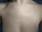 Гнойничковые высыпания на груди фото 1