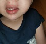 Сыпь вокруг рта у ребенка фото 1