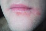 Проблема в области нижней губы фото 1