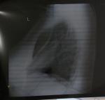 Расшифровка рентгена лёгких фото 3