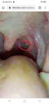 Белые точки (пупырышки) на слизистой во рту рядом с миндалинами фото 2