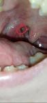 Белые точки (пупырышки) на слизистой во рту рядом с миндалинами фото 1