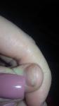Грибок, дистрофия или что то другое с ногтем у ребенка? фото 3