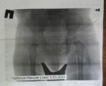 Помогите расшифровать описание снимка тазобедренного сустава фото 1