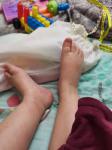 Ребёнок чешет руки в области сгиба и ноги фото 1