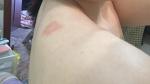 Розовое пятно на плече, красные прыщики на белом по телу фото 4