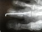 Операция по поводу молоткообразной деформации 2-го пальца правой стопы фото 4