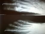 Операция по поводу молоткообразной деформации 2-го пальца правой стопы фото 3