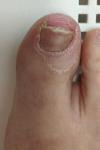 Больше 6 лет страдаю грибковым заболеваниям ногтя на ноге фото 1