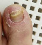 Больше 6 лет страдаю грибковым заболеваниям ногтя на ноге фото 2