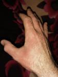 Какая то аллергия на руке фото 1