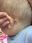 Увеличен лимфоузел у ребёнка за ухом фото 1