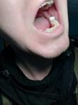 Болит зуб и воспален лимфоузел фото 1
