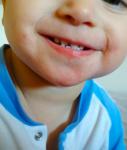Красные высыпания вокруг рта у ребенка, шелущащиеся пятно с корочкой фото 2