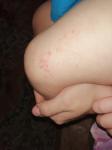 Сгруппированная Сыпь на ноге фото 3