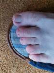 Зуд пальцев ног фото 4