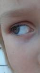 Черная точка на белке глаза у ребенка фото 2
