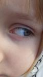 Черная точка на белке глаза у ребенка фото 1