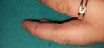 Шелушение, зуд, трещины пальцев рук фото 2
