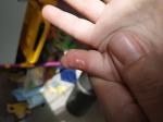 Высыпания, белые пупырышки, болячка около ногтя фото 4