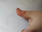 Высыпания, белые пупырышки, болячка около ногтя фото 3