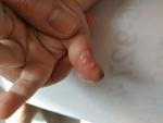 Высыпания, белые пупырышки, болячка около ногтя фото 1