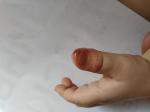 Высыпания, белые пупырышки, болячка около ногтя фото 2