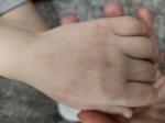 Аллергия на руках, как лечить? фото 2