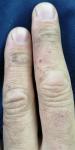 Зуд, кровяные трещины на среднем пальце руки фото 1