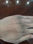 Потемнение и шелушение кожи на кистях рук фото 1