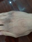 Потемнение и шелушение кожи на кистях рук фото 3