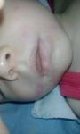 Сыпь вокруг рта у годовалого малыша фото 2